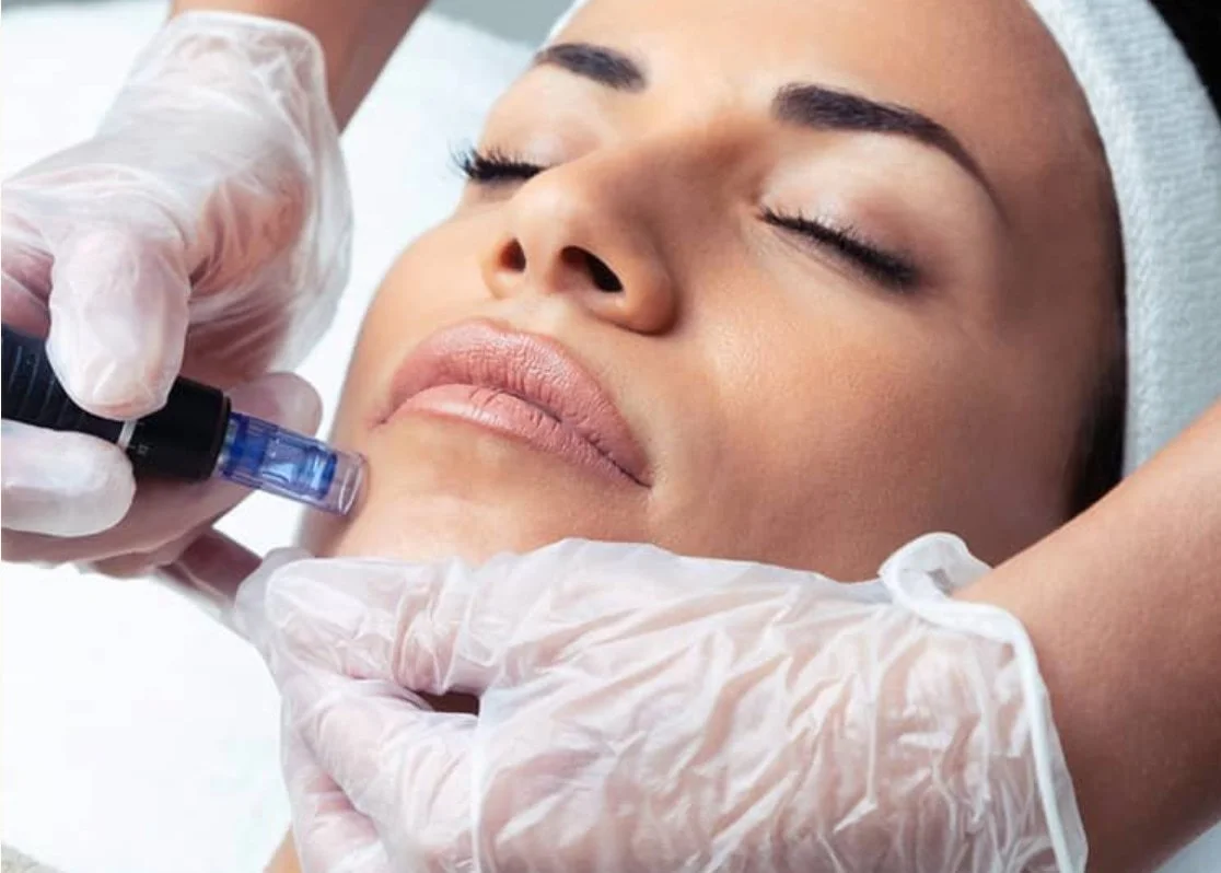 Microneedling